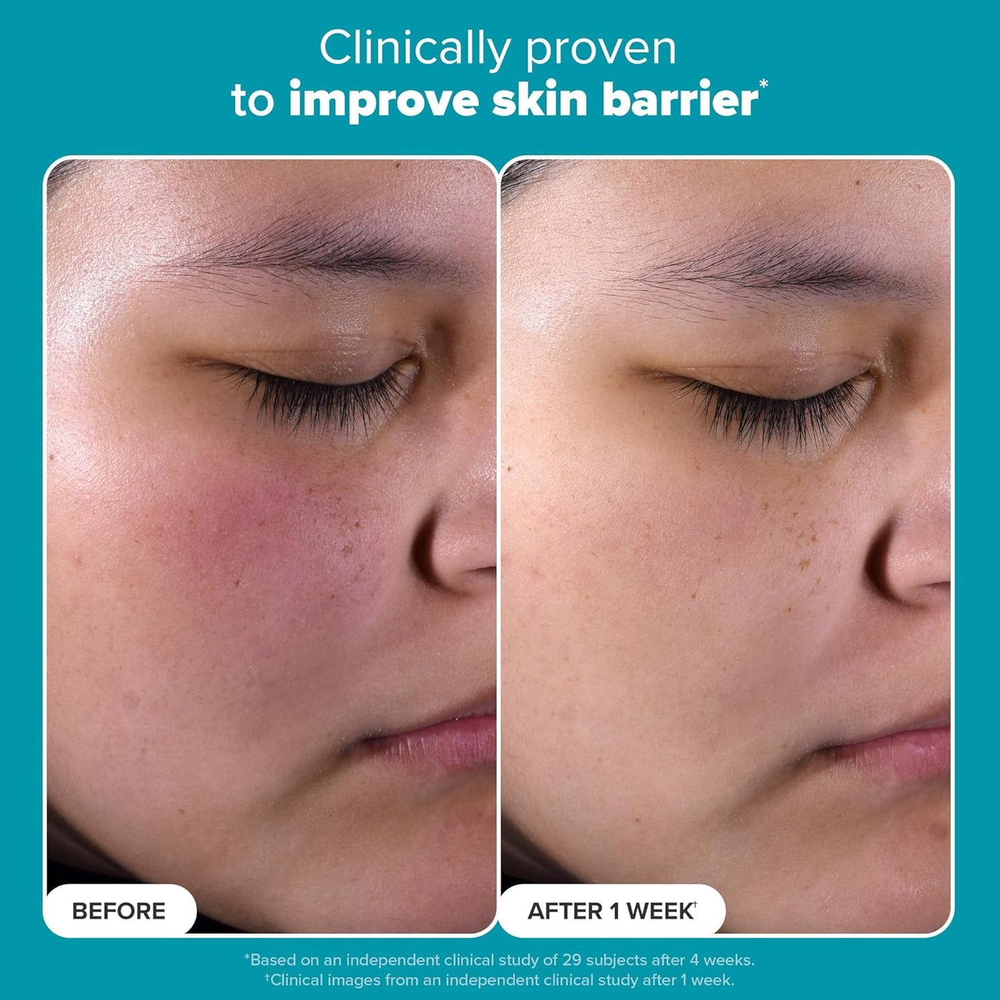 Paula’s Choice Skin Perfecting 2% BHA Liquid Exfoliant with Salicylic Acid – Pore Minimizer & Blackhead Remover for Smooth, Radiant Skin